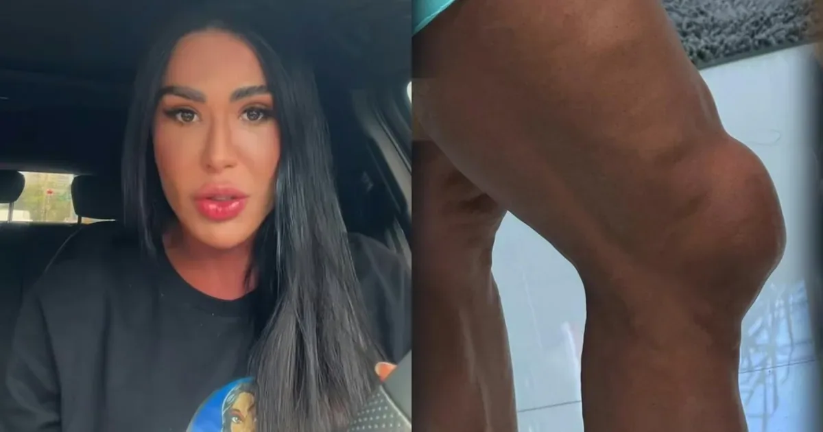 Gracyanne Barbosa revela inchaço no joelho durante preparação para reality de dança