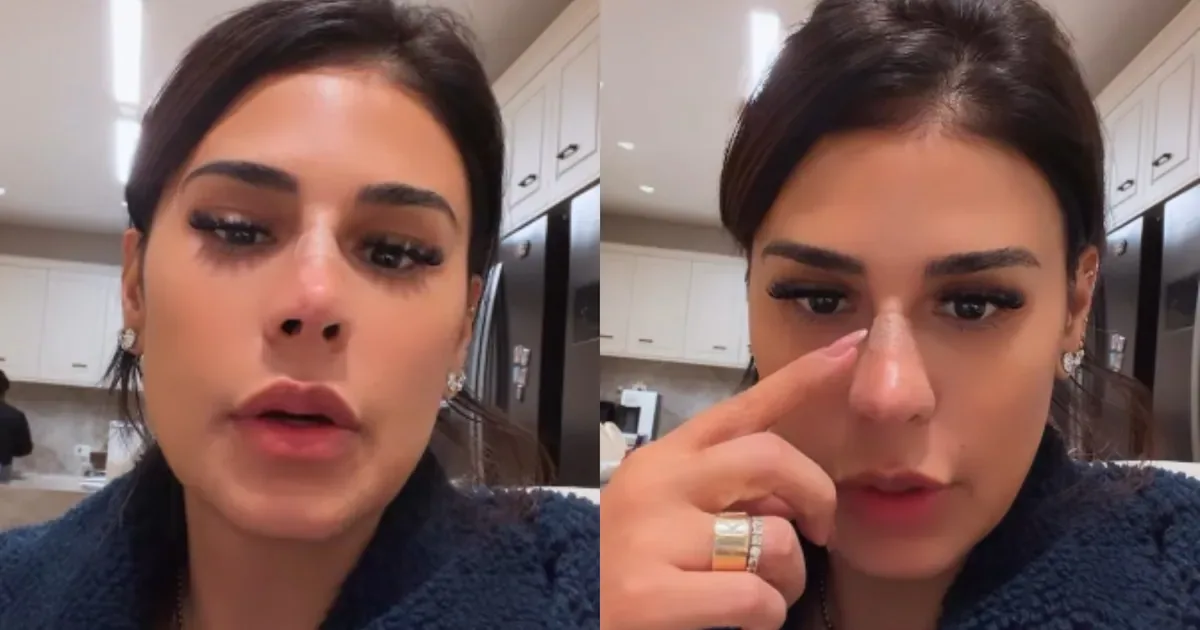 Simone Mendes revela novo procedimento no nariz e relembra cirurgias