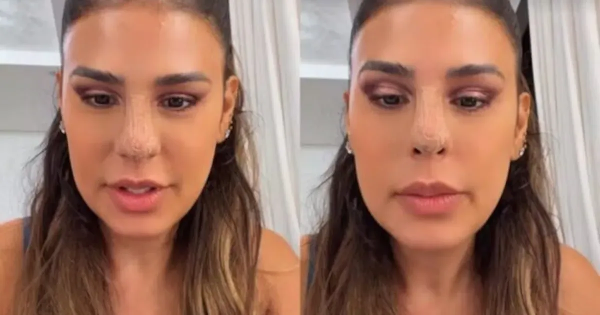 Simone Mendes relata susto com aparência após procedimento no nariz