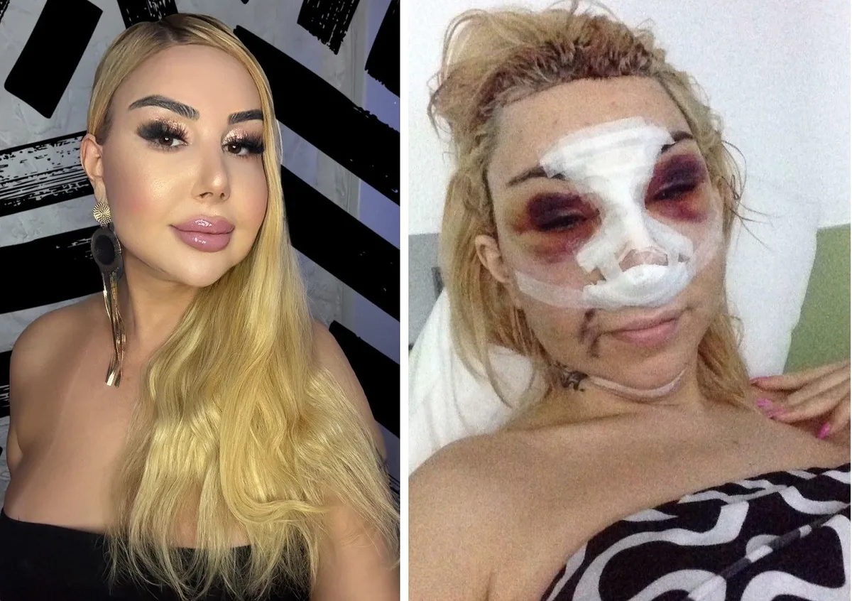 Patrícia Ribeiro relata complicações após uso de silicone industrial