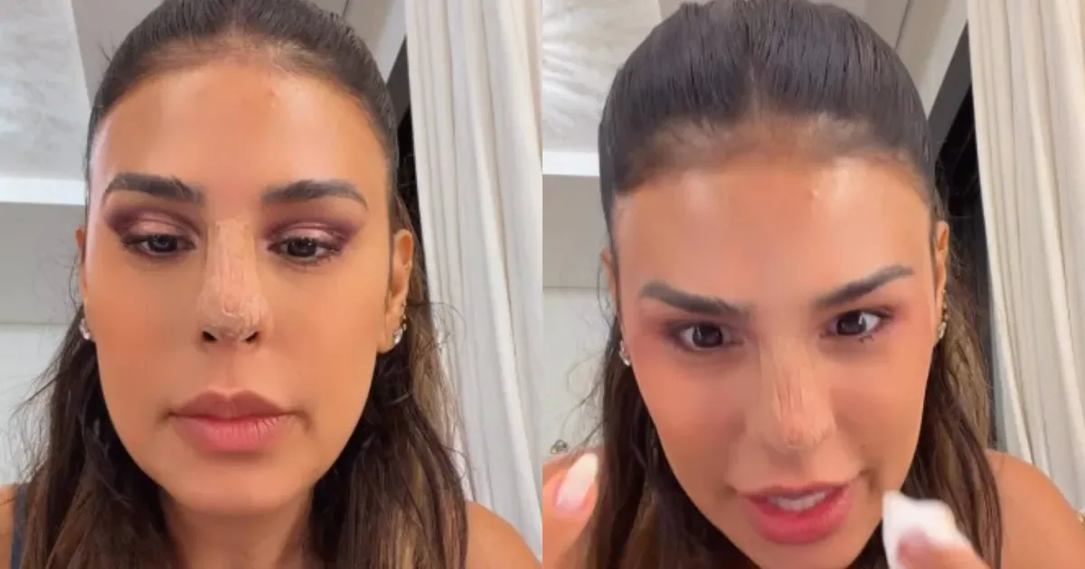 Simone Mendes relata susto ao ver nariz após procedimento estético